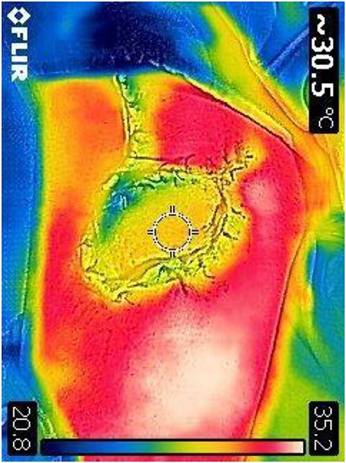 Post-op DDT image confirming perfusion of the flap.