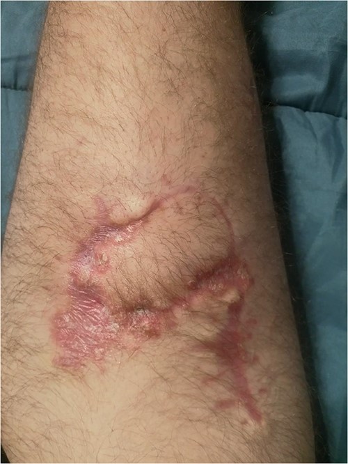 Surgical site at 1 month post-reconstruction.