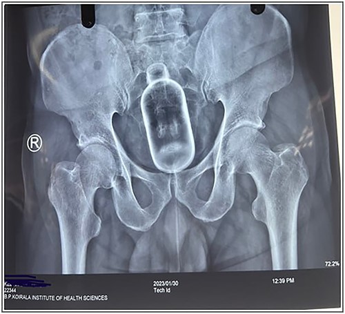 X-ray of abdomen and pelvis showing a foreign body at rectum.