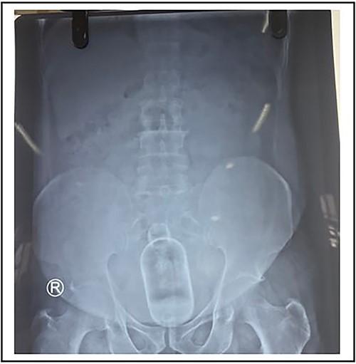 X-ray showing abdomen and pelvis with foreign body with no signs of perforation.