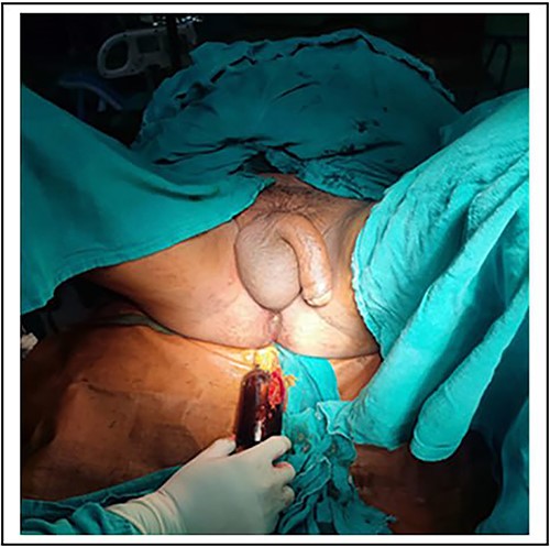 Picture showing removal of foreign body.