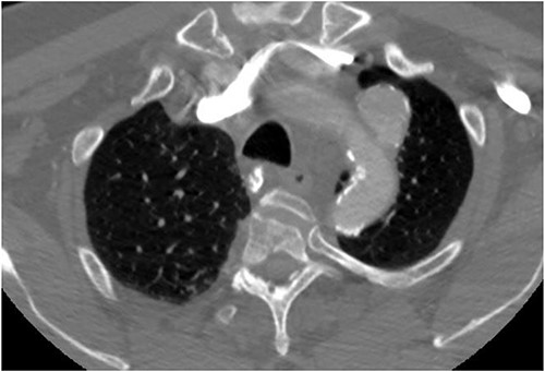 Preoperative CTA demonstrating LSA aneurysm; located at the origin from the aortic arch.