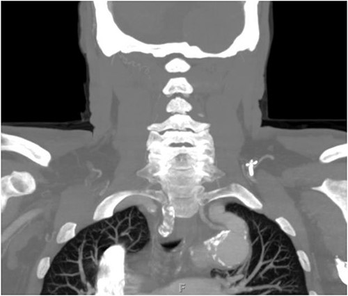Preoperative CTA demonstrating aberrant left vertebral artery originating from the aortic arch, just proximal to the LSA.