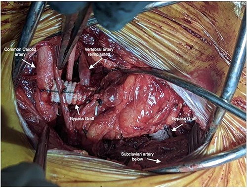 Intraoperative photo depicting left carotid to left subclavian bypass graft with left vertebral artery transposition into the graft.