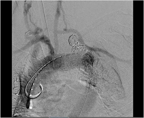 Aortic arch angiogram showing patency of the left carotid to subclavian artery bypass graft with vertebral artery implantation and showing coil embolization of the proximal left SAA.