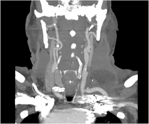 CT angiogram showing patency of the left carotid to subclavian artery bypass graft with vertebral artery implantation and showing coil embolization of the proximal left SAA.