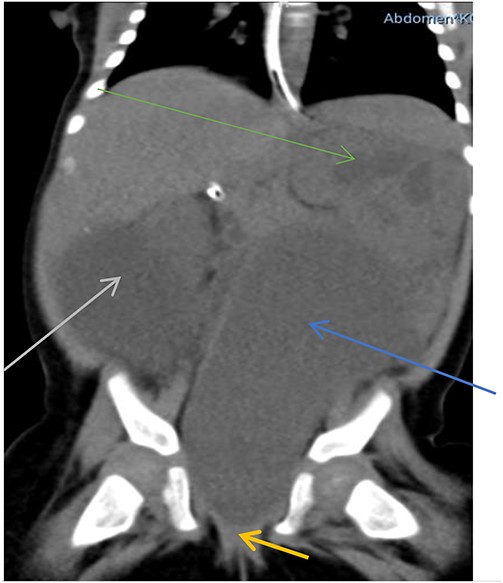 Hypodense mass arising from the uterus (blue arrow), connected to the upper vagina (yellow arrow) pushing the urinary bladder to the right (grey arrow) associated with hydronephrosis (green arrow).