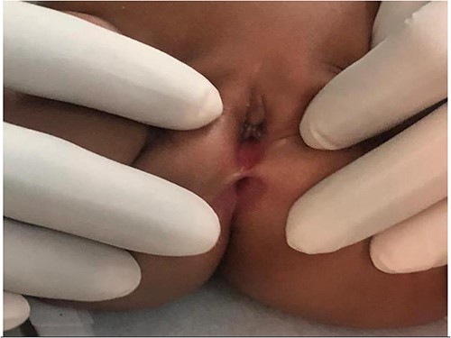 Vagina/introitus separated from the anus by very small septum (blue arrow).