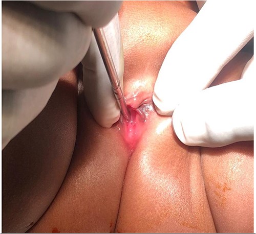 External urethral meatus located more proximal (deep inside introitus) as demonstrated by the metal bogie.