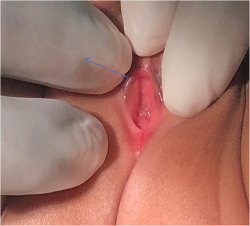 Absence of vaginal opening (blue arrow).