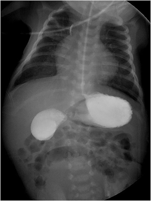 Gastroduodenal series showing the ‘double bubble’ sign.