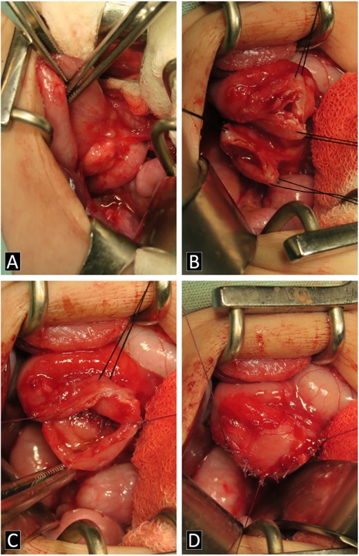 Intraoperatively images. (A) AP is shown in the second portion of the duodenum. (B–D) Process of the diamond-shaped-duodenoduodenostomy anastomosis.