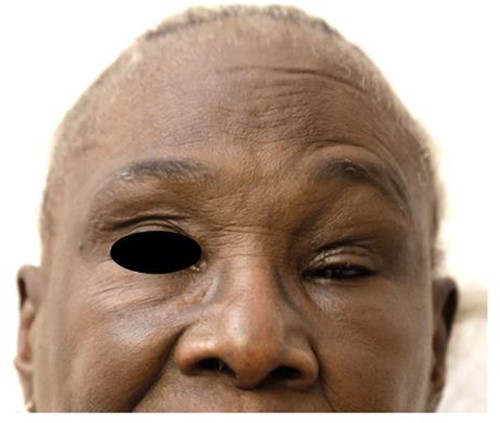 Swelling of left upper and lower eyelids is noted.