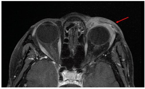 MRI showing a thickening of the left preorbital soft part (arrow), infiltrating the glandular compartments and lacrimal collectors with no alteration of intra or extraconic retro-septal fat.