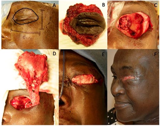 A: Delimitation of the cutaneous resection; B and C: left orbital exenteration including the muscles, nerves and fatty issues to the beyond to the periosteum of the orbit cavity and the upper and lower eyelid; D and E: reconstruction with a free anterolateral thigh flap used as an island flap; F: 3-month post-operative picture of the patient.