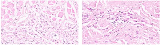 Histology of signet-ring cell/histiocytoid carcinoma of the eyelid in the subcutis and dermis; samples obtained after fixation and paraffin embedding showed numerous tumor cells with a central vacuole and an eccentric, nucleolated nucleus; those tumoral cells were identifiable by an abundant clear or eosinophilic cytoplasm and a characteristic signet-ring.