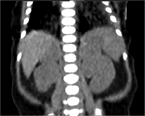 Coronal CT scan with IV contrast shows a uniform lobular enlargement of both adrenals (red arrows).