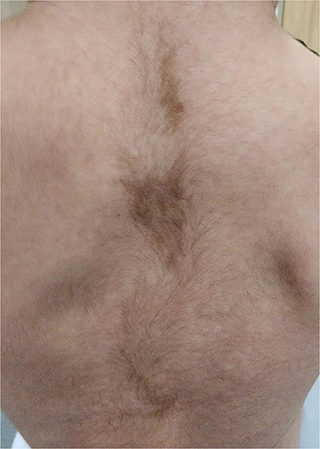 CAL spots; macules with jagged irregular edges (white arrows).