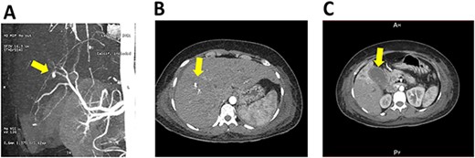 CT scan and angiography of hepatic pseudoaneurysm; (A) saccular hepatic pseudoaneurysm measuring 5.1 × 4.4 mm in the distal-third of the right hepatic artery; (B) the CT scan also showed dilation of the intrahepatic bile duct with a dense image inside, which was consistent with bleeding in the biliary tree; (C) gallbladder with thickened walls and radio dense images inside, compatible with the presence of stones.