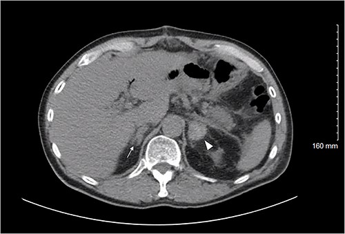 Axial CT abdomen/pelvis on POD 11 demonstrating the left adrenal gland (white arrowhead) with a high density 2.6 × 2.6 cm fluid collection; density is consistent with a subacute bleed. The right adrenal gland (white arrow) demonstrates thickening suggesting a small hemorrhage, less pronounced than the left.