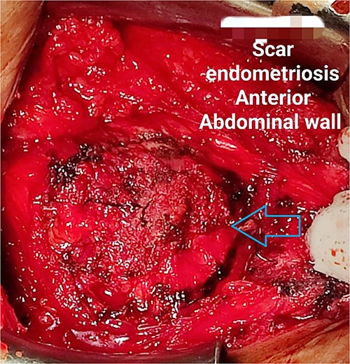 Anterior aspect of the endometrioma (pointed out by the arrow) delineated after dissection of skin flap.