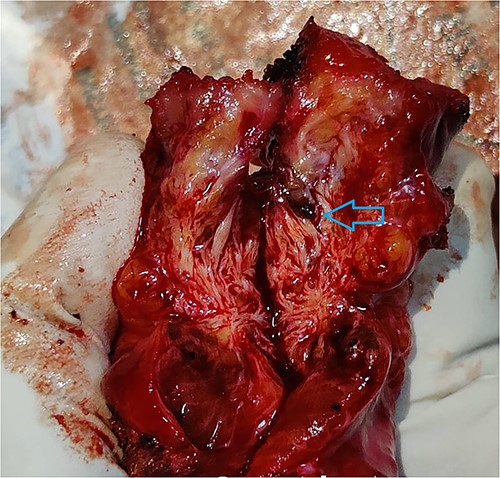 The cut section revealing areas of haemorrhage, pointed out by the arrow.