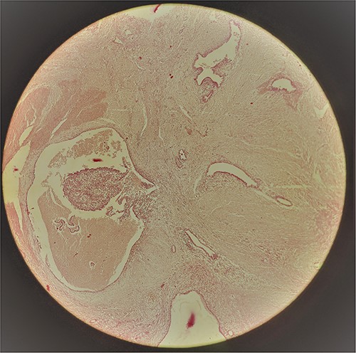 Photomicrograph showing scattered endometrial glands.