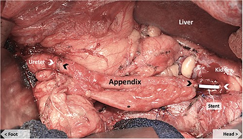 Appendiceal conduit (pre-anastomosis) showing JJ stent bridging the upper native ureter and the proximal end of the appendiceal graft. Black arrows mark the proximal and distal ends of the appendiceal graft. White arrows mark the proximal and distal ends of the native ureter.