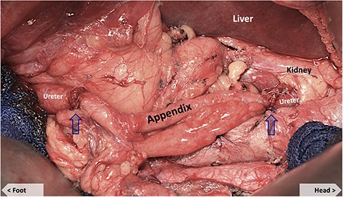 Appendiceal conduit (post-anastomosis). Arrows mark the proximal and distal uretero-appendiceal anastomosis.