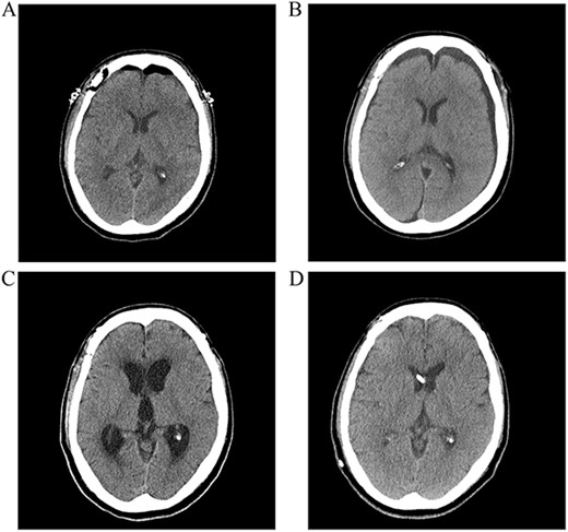 (A) Postoperative CT scan showing no subarachnoid or intraventricular hemorrhages. (B) Bilateral subdural fluid collection on postoperative day 13 CT scan. (C) Increased ventricle size by day 26. The patients developed symptoms of hydrocephalus. (D) A ventriculoperitoneal shunt was placed on day 47. Ventricle size decreased and clinical signs of hydrocephalus improved.