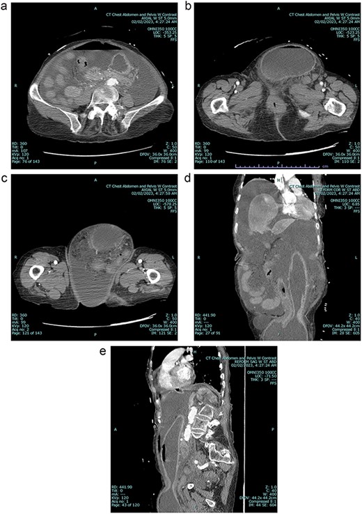 A Preoperative axial view at level of mid abdomen, demonstrating free intraabdominal fluid and air 1b: Preoperative axial view at level of groin, demonstrating stomach-containing left inguinal hernia 1c: Preoperative axial view at level of the mid thigh, demonstrating left inguinal hernia containing both the stomach and other viscera 1d: Preoperative coronal view, demonstrating stomach being pulled down into inguinal hernia sac 1e: Preoperative sagittal view, demonstrating stomach being pulled down into inguinal hernia sac, and associated free intraabdominal air.