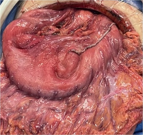Intraoperative photo of stomach following gastric repair.