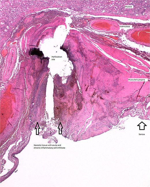 Histologic section of gastric perforation site with H&E stain, suggesting a pressure-related injury.