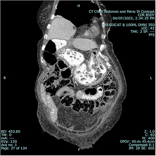 Postoperative sagittal view, demonstrating stomach back in normal anatomical position1.