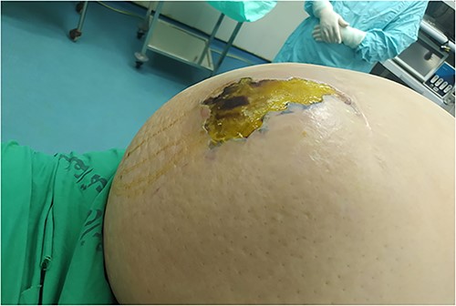 Necrotizing soft tissue infection of the anterior abdominal wall.