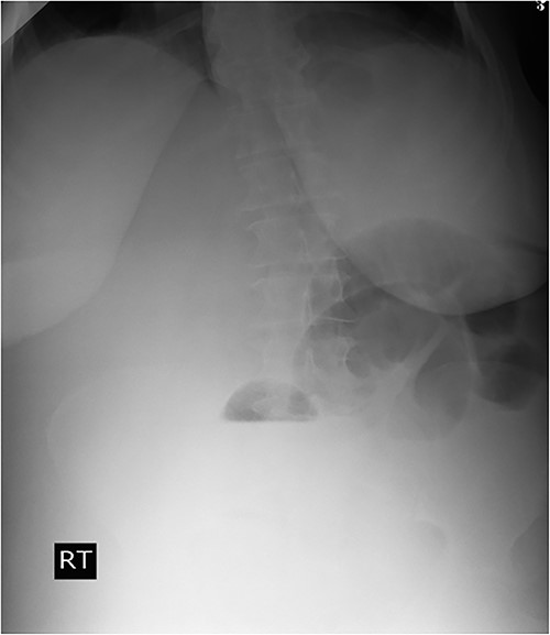 Plain abdominal X-ray demonstrated air-fluid levels of the small bowel.