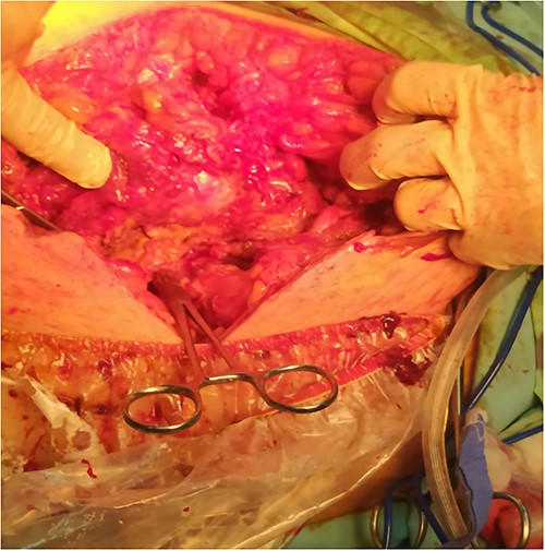 A left paramedian laparotomy incision.