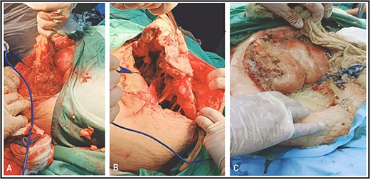 Surgical debridement and fasciotomy of the anterior abdominal wall.