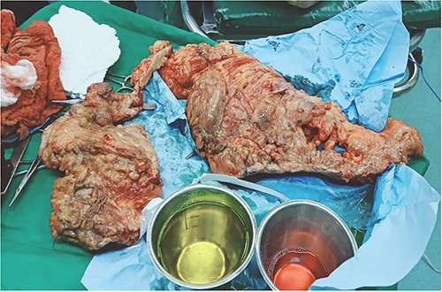 Gangrenous anterior abdominal wall resected during surgery.