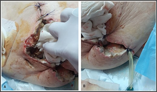 Suture approximation technique was done. At the site of maximum skin necrosis, the wound is left open for secondary healing, with a drain inserted in the abdominal wall.