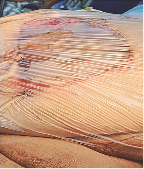 A plastic sheath over the exposed wound.