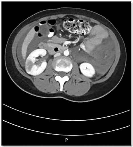 CT abdomen findings show significant thickening of the transverse colon with significant pericolic fat stranding; the right kidney shows wedge-shaped cortical hypodensities (could represent ischemic insult).