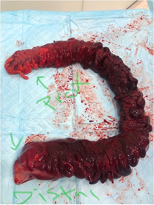 The full excised specimen from the exploratory laparotomy with left hemi and sigmoid colectomy, and transverse colostomy showing the proximal (transverse colon) and the distal (upper rectum) parts.