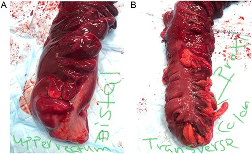 (left) Distal part of the excised specimen showing part of the upper rectum with healthy edge; (right) proximal part of the excised specimen showing part of the transverse colon with healthy edge.