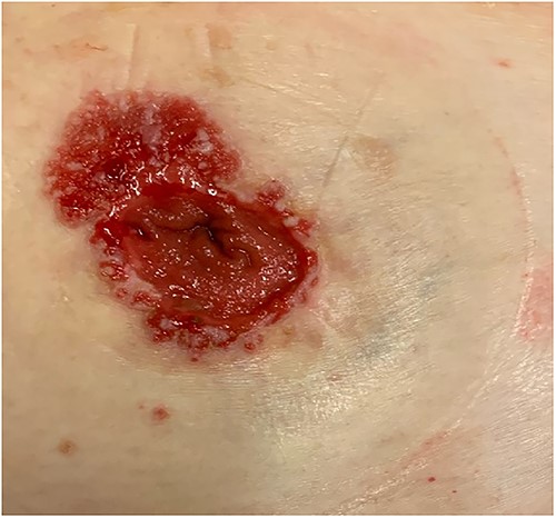 Peristomal skin abnormality.