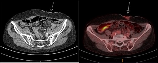 PET/CT scan showing minimal FDG stacking at the colostomy site.