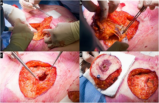 Intra-operative view: (a) resection of the peristomal area; (b) removal of the previous colostomy; (c) the defect including open fascia; (d) side-to-side resected area and the remaining defect.