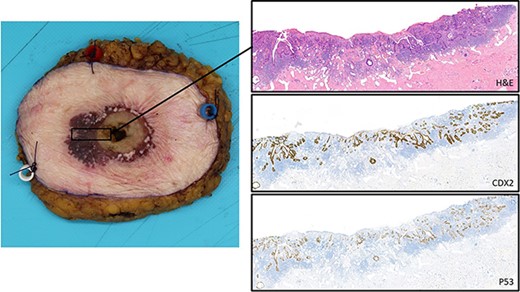 Histopathological examination showing the gross specimen and microscopic pictures; the H&E staining shows the superficial intestinal type adenocarcinoma with intra-epithelial pagetoid extension; the CDX2 staining accentuates the intestinal differentiation with pagetoid extension; the P53 staining highlights the neoplastic nature of this (intra-epithelial) lesion.