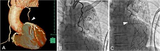 (A) contrast-enhanced MSCT on postoperative Day 3 showing peripheral LITA graft occlusion (arrowhead); (B, C) postoperative CAG demonstrated thrombotic occlusion in the peripheral LITA graft (arrowhead), which was considered resolvable by PCI.