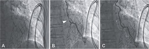 A 0.014-inch guidewire (SION Blue, Asahi Intecc, Aichi, Japan) was inserted into the LITA graft under intravascular ultrasound (Altaview; Terumo, Tokyo, Japan) guidewire; the diameter of the lesion was about 2 mm, therefore balloon dilation (Ryurei 2.0 × 20 mm, Terumo, Tokyo, Japan) was performed first from distal to proximal (A); angiography showing hematoma formation in the lesion, which was not resolved by the administration of nitroglycerin (B, arrowhead); three stents (Synergy 2.25 × 12 mm, 2.25 × 28 mm, 2.25 × 20 mm, Boston Scientific, USA) were overlappingly placed to cover the lesion (C, dotted line), and there was a satisfactory angiographic result.